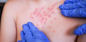 Autoridades de salud en Guanajuato informaron sobre la detección de un caso sospechoso de sarampión importado en el municipio de León.