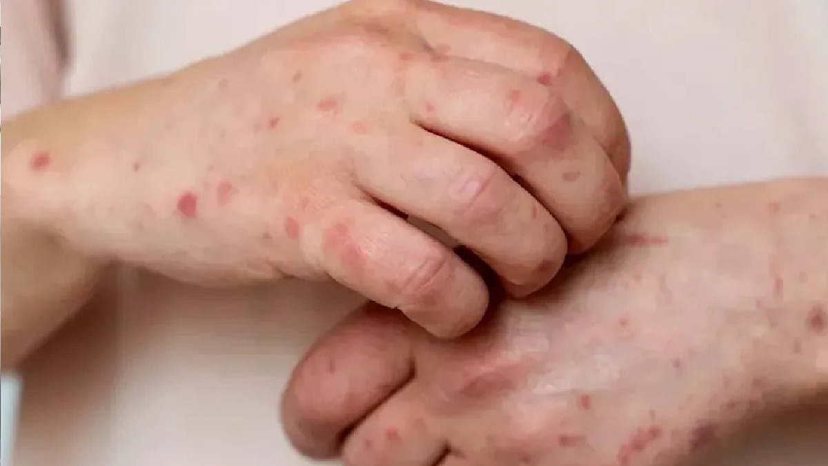 Paciente con sarampión, enfermedad que terminó con la vida de un niño de 8 años en Durango.