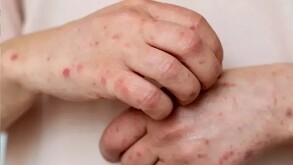 Paciente con sarampión, enfermedad que terminó con la vida de un niño de 8 años en Durango.