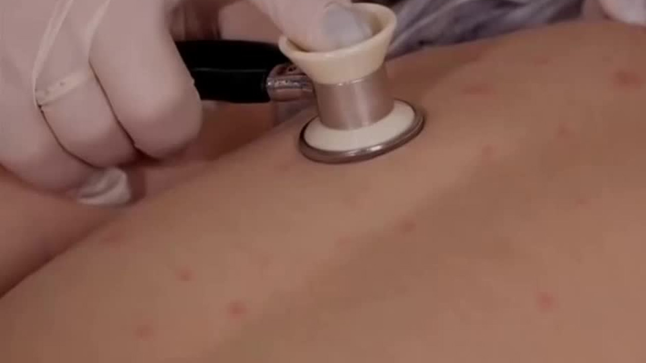 El secretario de Salud de Tabasco informó que el estado registra 34 casos confirmados de sarampión y ocho en estudio.