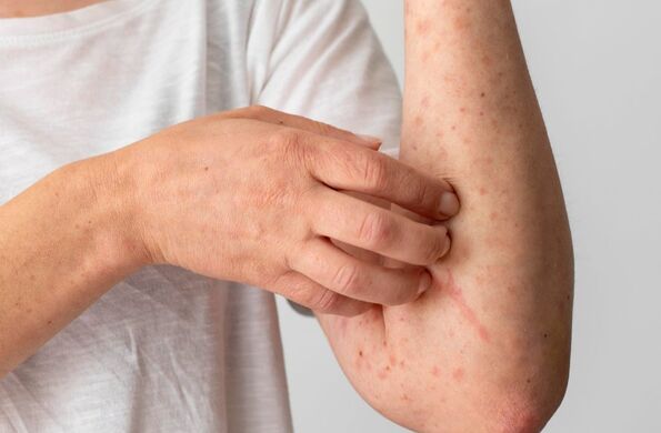 Conoce los lugares donde se registran contagios de sarampión en Puebla, se detecta brote en el Mercado Hidalgo.