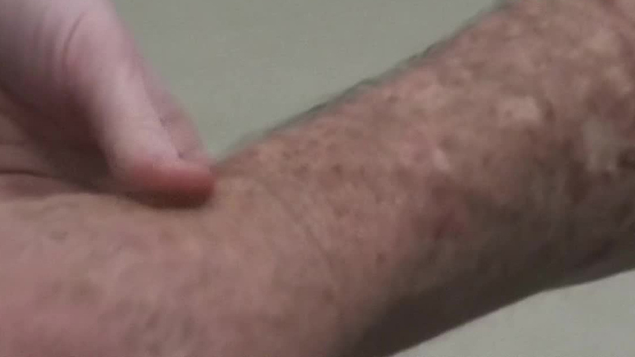 México acumula 9,478 casos confirmados de sarampión y 29 defunciones durante el periodo 2025–2026, informó la Secretaría de Salud.