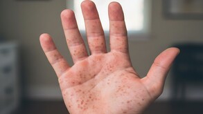 Del 1 de enero al 17 de febrero Nuevo León acumula 398 casos probables