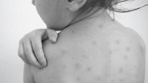 La falta de vacunación ha sido un factor común en las defunciones por sarampión registradas en Jalisco.