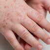 las manos de un niño con brote de sarampión