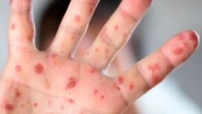 Paciente con marcas por sarampión.