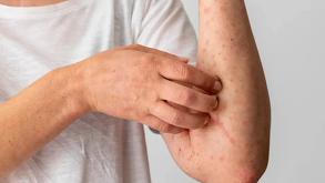 México enfrenta un repunte crítico de sarampión con 8,332 casos. Clara Brugada, Jefa de Gobierno, advierte que en CdMx el foco está en adultos de 20 a 49 años.