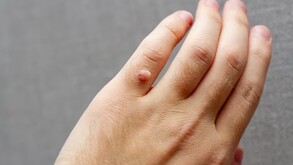 Mano contagiada de VPH