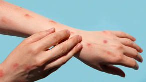 De acuerdo con el informe diario sobre el brote de sarampión en México, Nuevo León alcanzó ocho casos confirmados de la enfermedad en lo que va del 2026.