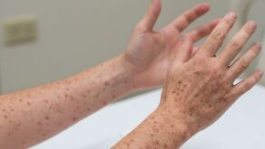 Suman 33 casos de sarampión en Nuevo León; a nivel nacional se superan los 11 mil