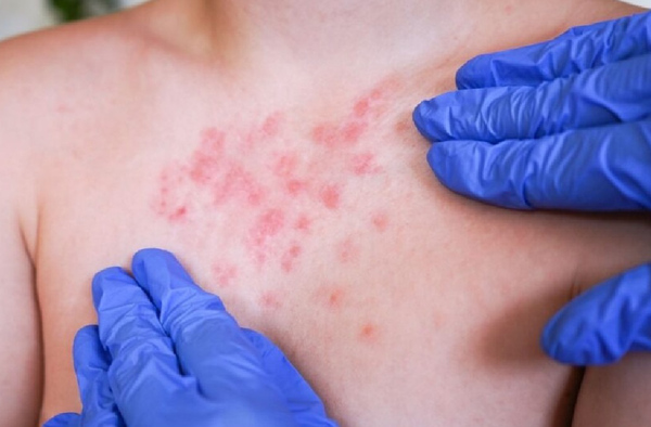 Con 217 casos activos y una lamentable defunción, la meta es aplicar 1.6 millones de vacunas en un mes para lograr la inmunización colectiva.