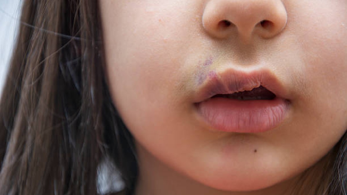 Hendiduras orofaciales en niños