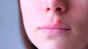 Las verrugas por VPH pueden salir en los genitales, ano, boca o la garganta.