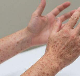 Suman 33 casos de sarampión en Nuevo León; a nivel nacional se superan los 11 mil