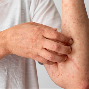 La Secretaría de Salud confirma 32 muertes por sarampión en México. En la UNAM se instaló un mega módulo de vacunación gratuito.