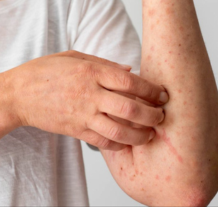 La Secretaría de Salud confirma 32 muertes por sarampión en México. En la UNAM se instaló un mega módulo de vacunación gratuito.