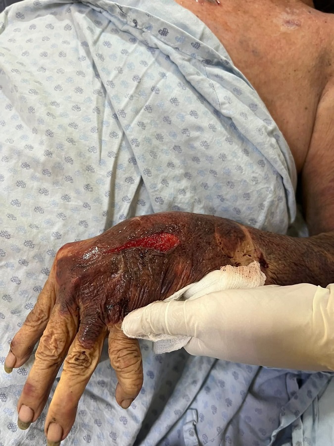 Mano de una mujer anciana con una cortada profunda.