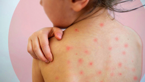 Confirman sexto caso de sarampión en Hidalgo; hay resistencia a la vacunación