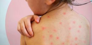 Confirman sexto caso de sarampión en Hidalgo; hay resistencia a la vacunación