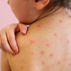Confirman sexto caso de sarampión en Hidalgo; hay resistencia a la vacunación