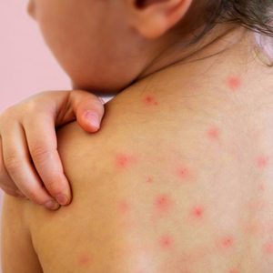 Confirman sexto caso de sarampión en Hidalgo; hay resistencia a la vacunación