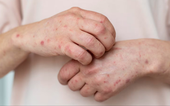 La Secretaría de Salud confirmó 35 muertes por sarampión en México desde 2025. Hay casi 7 mil contagios confirmados y Jalisco encabeza la lista nacional.