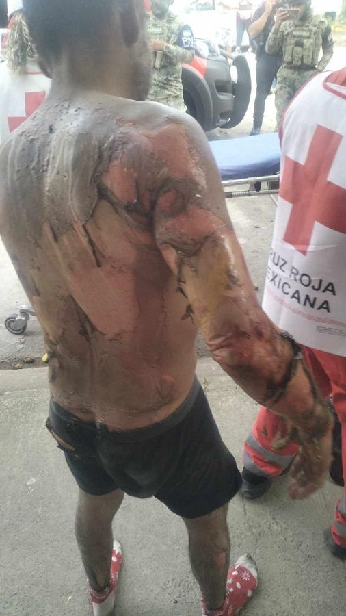 Hombre con severas quemaduras en la espalda y brazo.