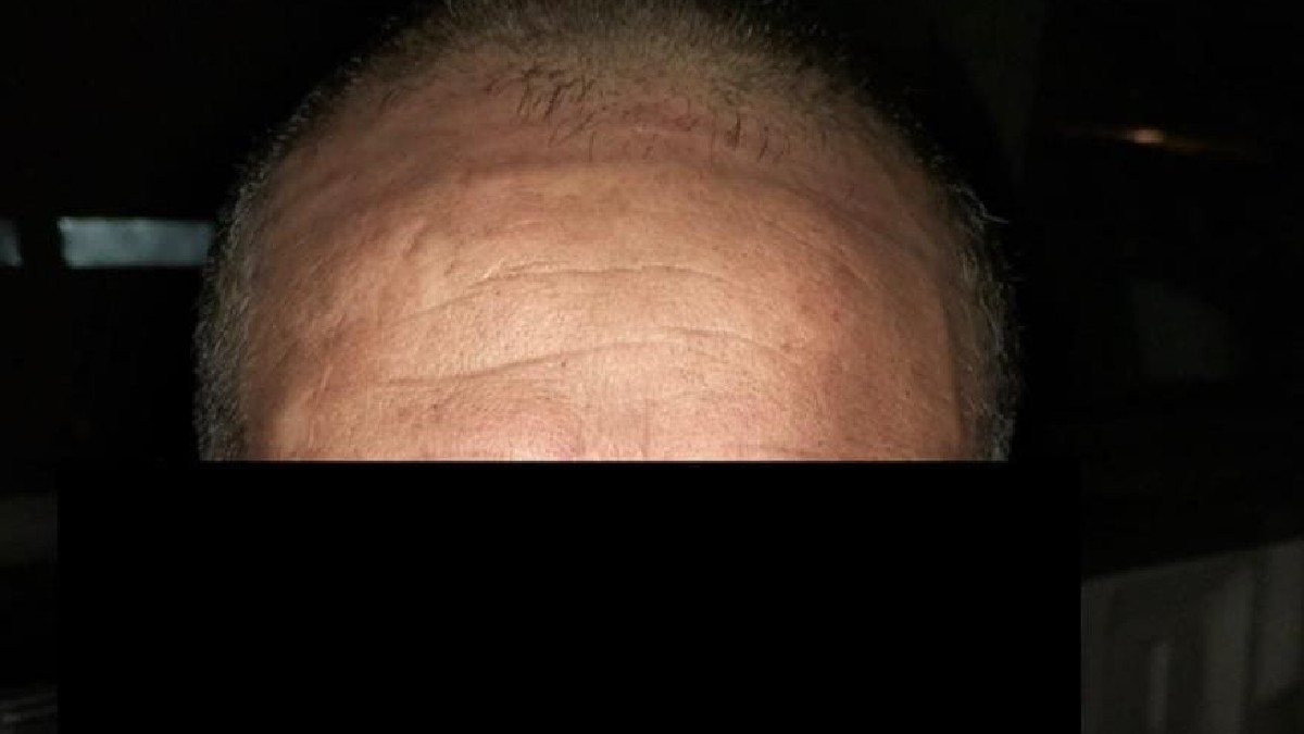 Frente de hombre con calvicie y cara censurada