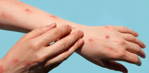 De acuerdo con el informe diario sobre el brote de sarampión en México, Nuevo León alcanzó ocho casos confirmados de la enfermedad en lo que va del 2026.