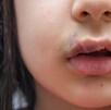 Hendiduras orofaciales en niños