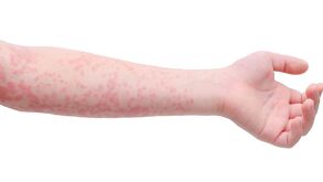 Brazo con brote de sarampión