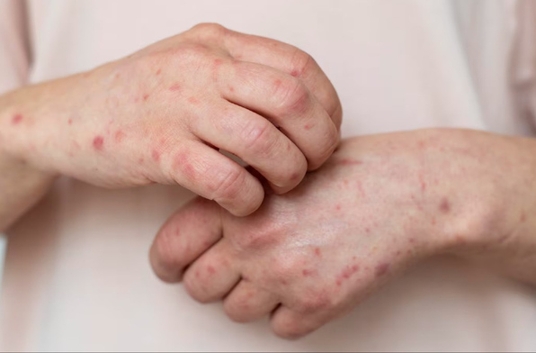 La Secretaría de Salud confirmó 35 muertes por sarampión en México desde 2025. Hay casi 7 mil contagios confirmados y Jalisco encabeza la lista nacional.