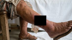 Primer caso en Edomex de gusano barrenador en humanos es atendido.