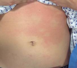 Uno de los síntomas o signos por intoxicación del consumo de pescado