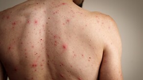 Hombre con sarampión visto de espaldas con ronchas rojas por todo el cuerpo delante de un fondo color café