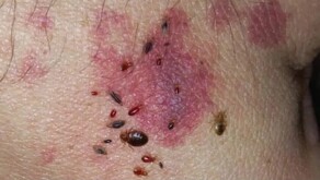 Parte de la piel de una persona con ronchas amoratadas picadura de chinches alrededor en un brote de la enfermedad de Chagas