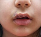 Hendiduras orofaciales en niños