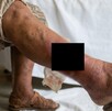 Primer caso en Edomex de gusano barrenador en humanos es atendido.