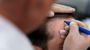 Injerto de cabello a un hombre