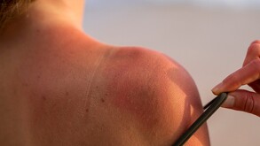 una persona a la cual se le puede percibir un grado de quemadura en la piel por la exposición en el sol
