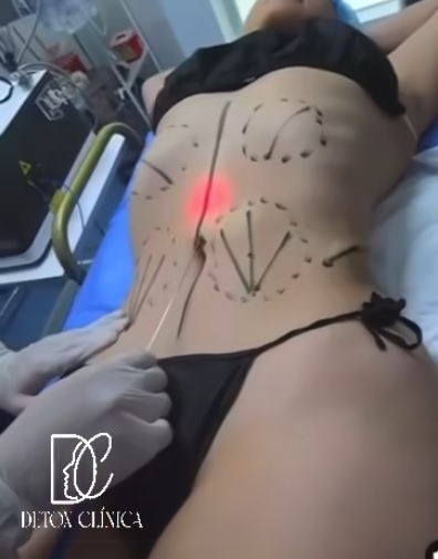 Imagen de una liposucción en Puebla.