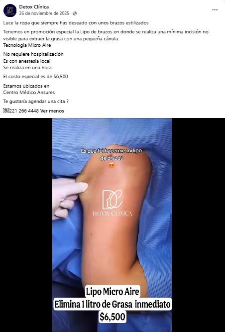 Publicación en Facebook de un tratamiento de liposucción.