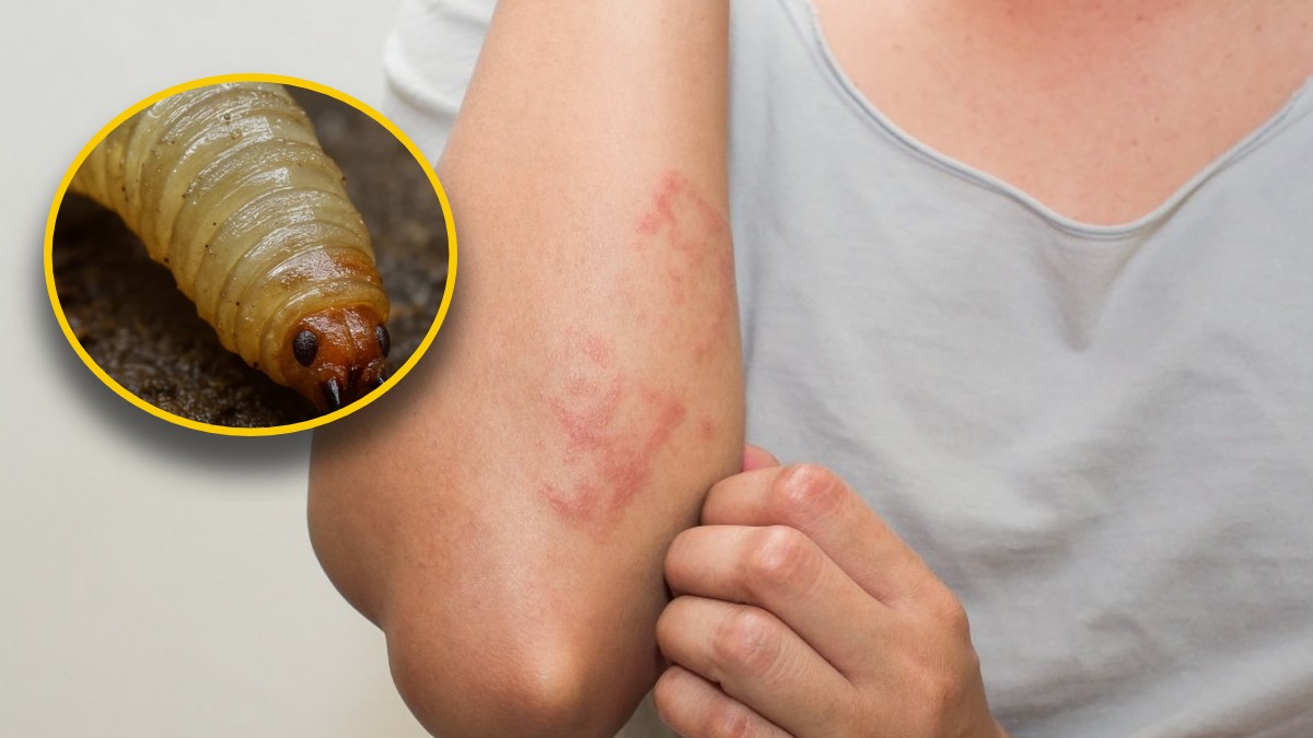 En la miasis, las larvas de las moscas se meten bajo la piel o en heridas abiertas