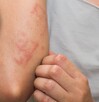 En la miasis, las larvas de las moscas se meten bajo la piel o en heridas abiertas
