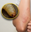 En la miasis, las larvas de las moscas se meten bajo la piel o en heridas abiertas