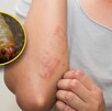 En la miasis, las larvas de las moscas se meten bajo la piel o en heridas abiertas