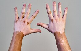 una persona muestra sus manos con vitiligo