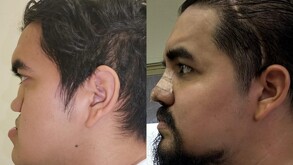 Especialistas del IMSS reconstruyeron el rostro de un paciente de 29 años mediante tres cirugías de alta complejidad realizadas en la UMAE No. 21 de Nuevo León.