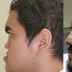 Especialistas del IMSS reconstruyeron el rostro de un paciente de 29 años mediante tres cirugías de alta complejidad realizadas en la UMAE No. 21 de Nuevo León.