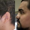 Especialistas del IMSS reconstruyeron el rostro de un paciente de 29 años mediante tres cirugías de alta complejidad realizadas en la UMAE No. 21 de Nuevo León.